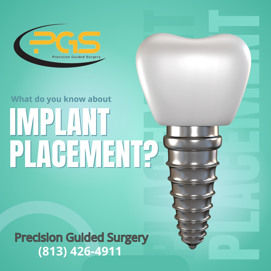 What do you know about Implant Placements?